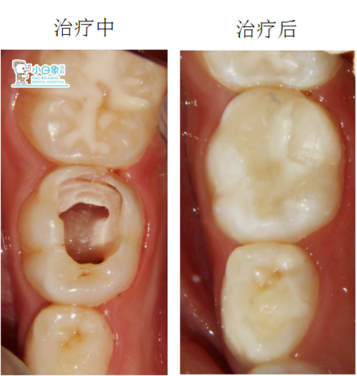 x线片:85低密度影像达髓角 诊断:85慢性牙髓炎 治疗方案:85根管治疗