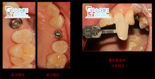 治 疗 过 程:24去除愈合帽,测isq值近中,远中73,近颊,远颊,颊侧,舌侧
